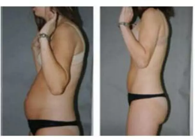 ABQ Lipo Light