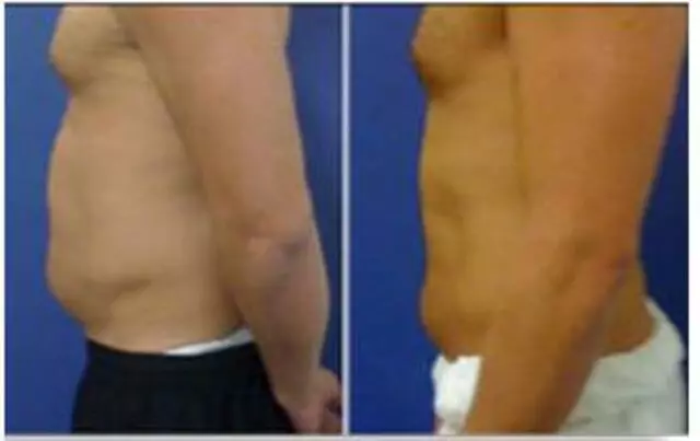 ABQ Lipo Light
