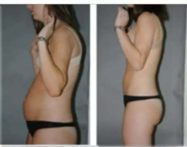 ABQ Lipo Light